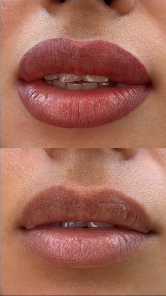 Avant-après d’une dermopigmentation naturelle des lèvres, mettant en évidence une harmonisation de la teinte et du contour pour un résultat doux, subtil et naturel, sans effet maquillage marqué.